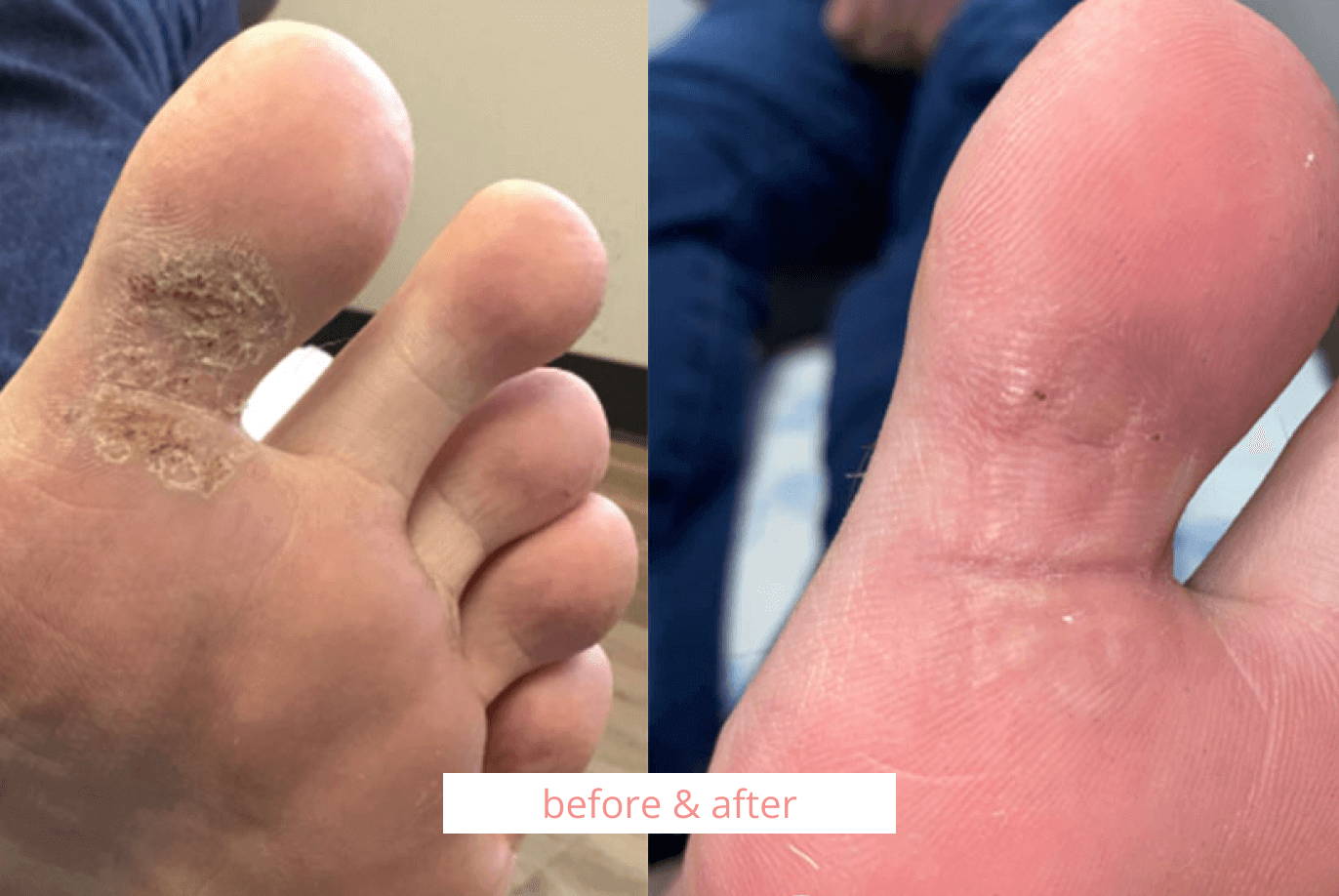 Skintify™ Remover Pen for Plantar warts